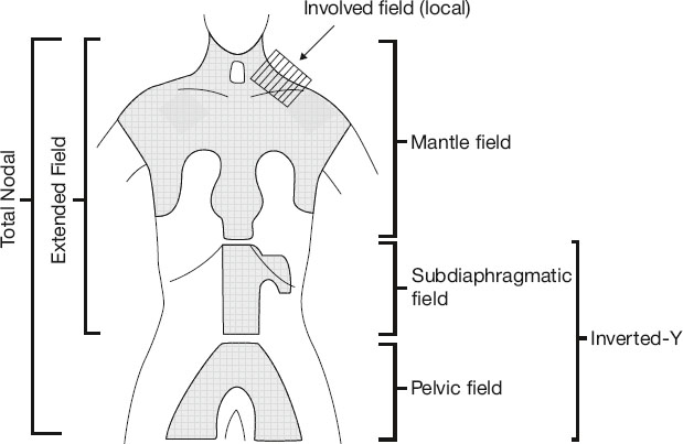 Diagram of radiation treatment fields on a human outline, showing involved field near the neck, mantle field across chest, subdiaphragmatic field in abdomen, pelvic field, and inverted-Y configuration for extended nodal coverage.