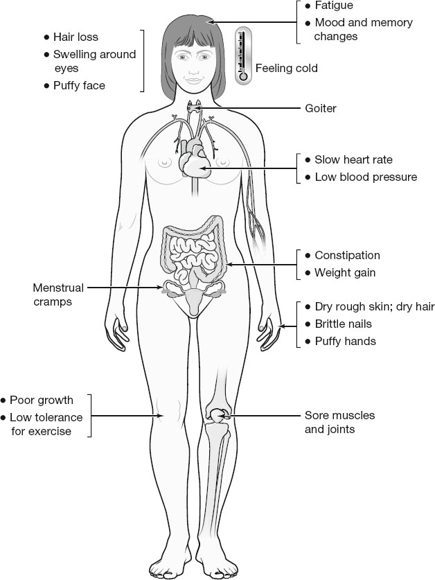 Diagram of a female body showing symptoms of hypothyroidism, including fatigue, feeling cold, goiter, slow heart rate, weight gain, constipation, dry skin, brittle nails, hair loss, swelling, menstrual cramps, poor growth, and joint pain.