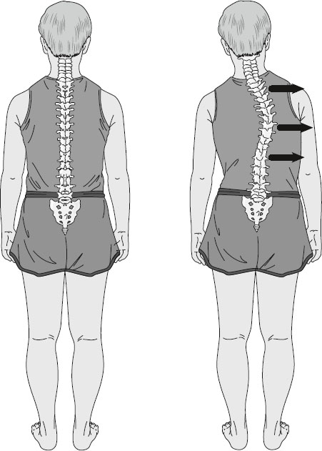 Illustration showing two back views of a person: left image with a straight spine, right image with a curved spine and arrows indicating lateral deviation, representing scoliosis.