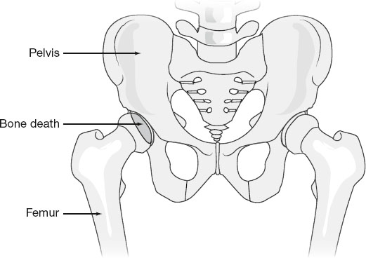 Illustration of the pelvic region showing labeled bones: pelvis at the top, femur on both sides, and an area marked as bone death near the hip joint, indicating avascular necrosis.