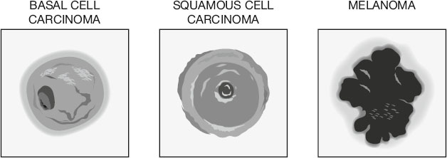 Illustration showing three types of skin cancer: basal cell carcinoma with a round lesion, squamous cell carcinoma with layered appearance, and melanoma depicted as an irregular dark mass.